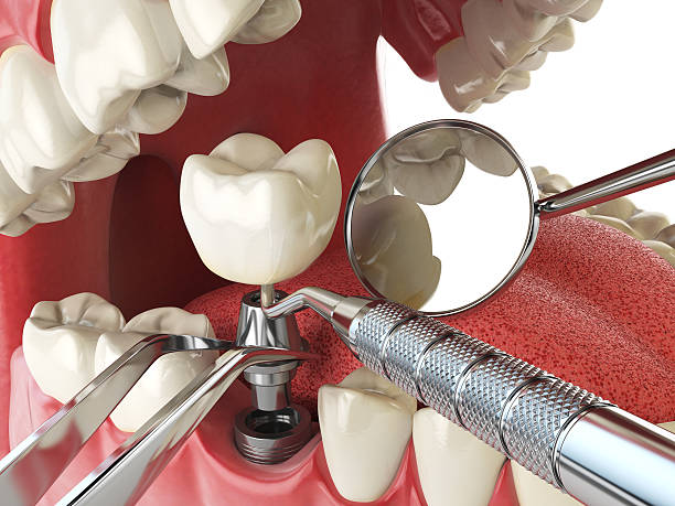 Best Emergency Dental Care for Broken or Chipped Teeth in Elizabeth, CO